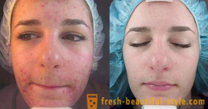 Sura peeling för ansiktet: recensioner, bilder före och efter