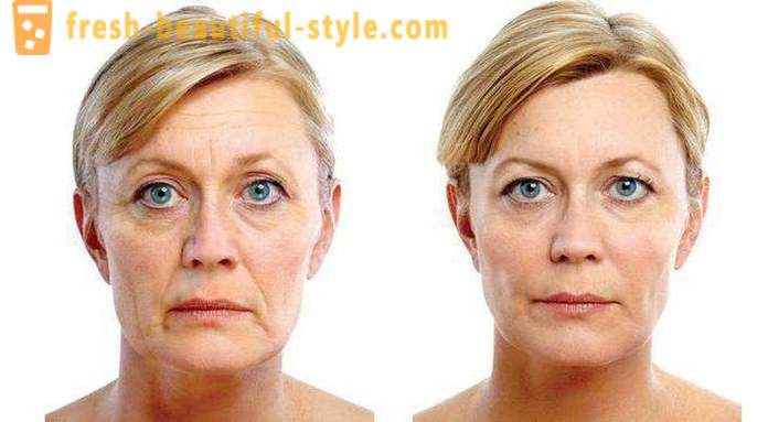 RF-ansiktslyftning: recensioner läkare kosmetologer, beskrivning av förfarandet, kontraindikationer. RF-lyftning