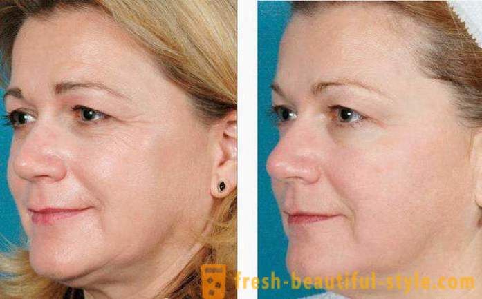 RF-ansiktslyftning: recensioner läkare kosmetologer, beskrivning av förfarandet, kontraindikationer. RF-lyftning