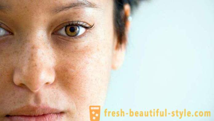 Bruna fläckar i ansiktet: orsakerna till och behandlingar. bruna fläckar
