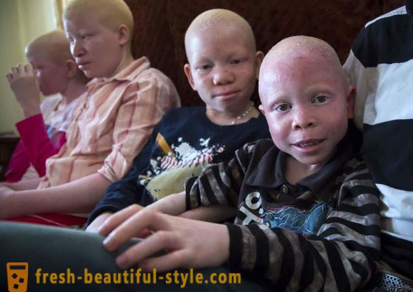 Den tragiska historia tanzaniska albiner
