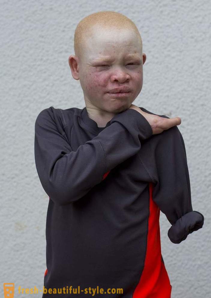 Den tragiska historia tanzaniska albiner