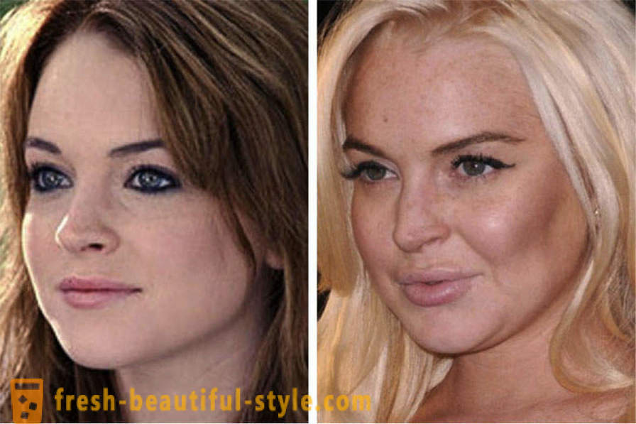 15 kändisar, slutade dåligt med Botox