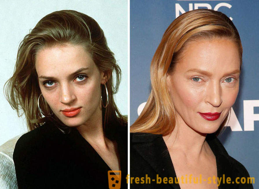 15 kändisar, slutade dåligt med Botox