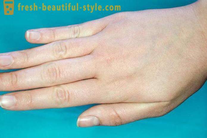 Fjällande hud i ansiktet och händerna: möjliga orsaker och funktioner i vården