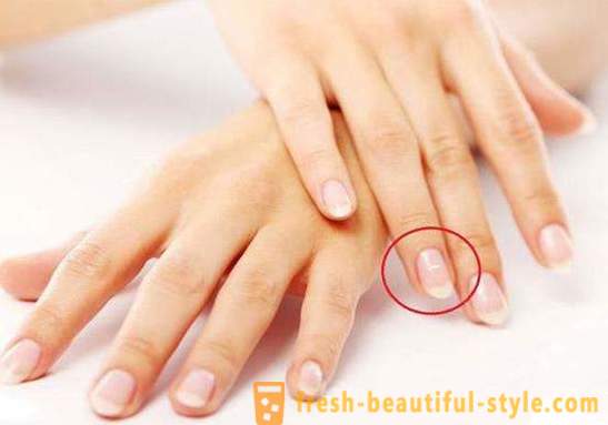 Vita fläckar på naglarna på fingrarna: orsakerna till och behandling
