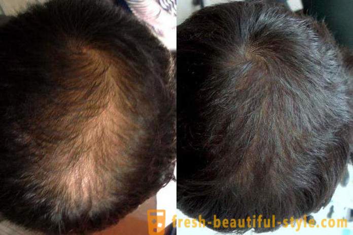 Läkemedel med minoxidil för hår: omdömen, funktioner och beskrivning av tillämpningen av bästa