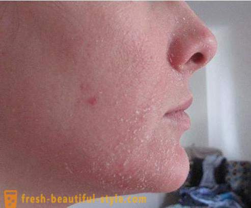 Varför fjällande hud i ansiktet? hudproblem ansiktet