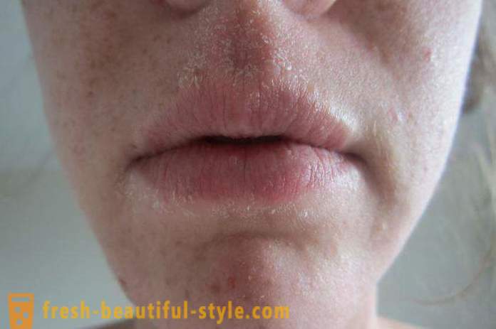 Varför fjällande hud i ansiktet? hudproblem ansiktet