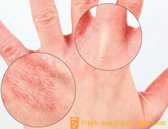 Torr hud på händerna: orsaker. Mycket torr hud, vad göra?