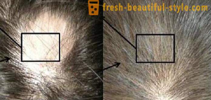 Mesotherapy för hår: smink verktyg och kontra
