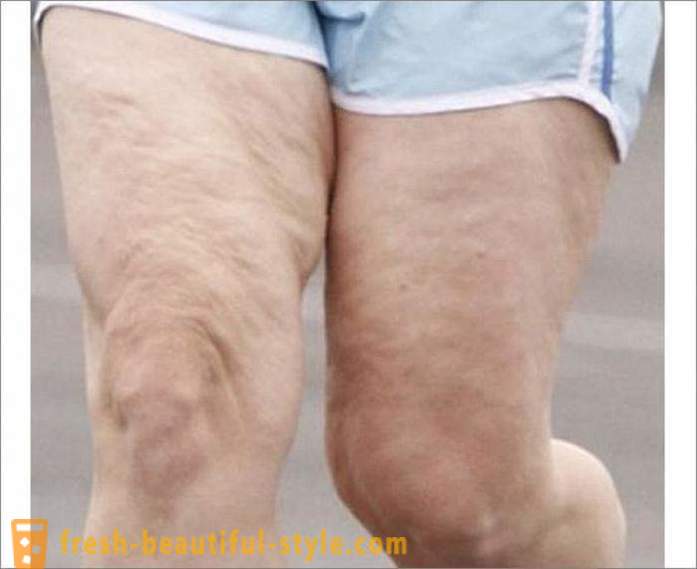 Hur man kan bli av med celluliter på ben? Övningar för benen på celluliter