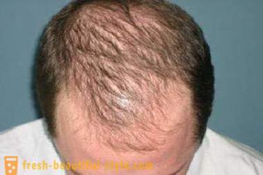 Hur att påskynda tillväxten av hår på huvudet? Restaurering av hårväxt