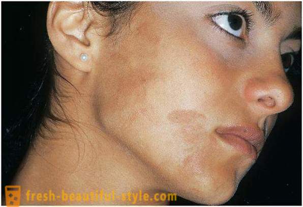 Ta hand om sin skönhet och ungdom: orsakar pigmentering i ansiktet